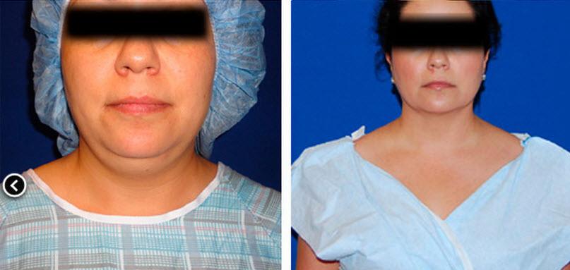 Check out this amazing before &amp; after: bit.ly/1NWWVqA