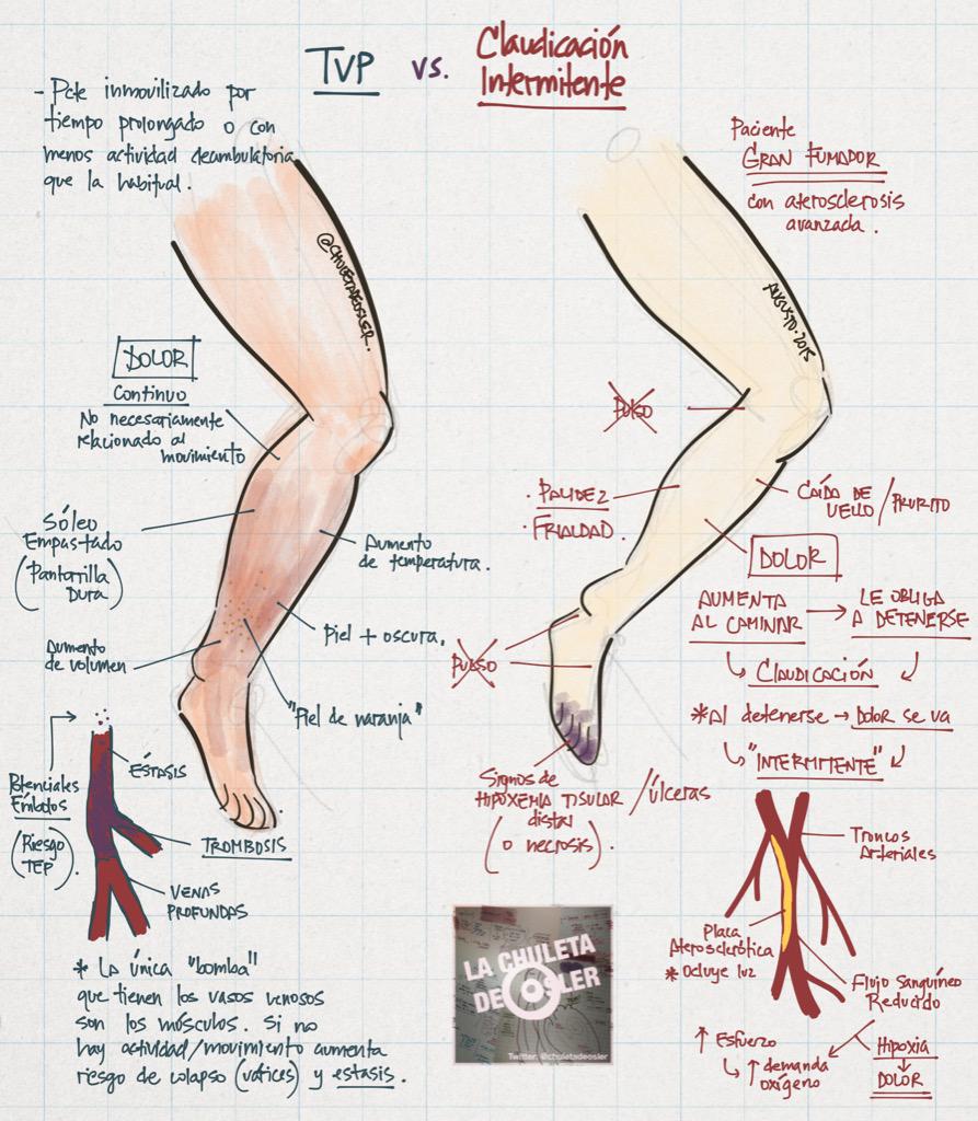 chuletadeosler's tweet photo. Trombosis venosa profunda vs. claudicación intermitente. #medicinainterna #MFyC #cardiologia #cirugiavascular http://t.co/PT1LsnpQID