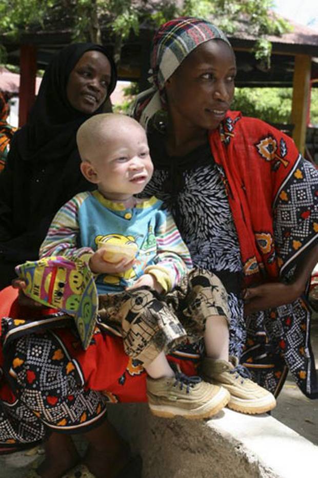 Malawi police told to 'shoot' criminals attacking albinos for body parts ind.pn/1GsX99M