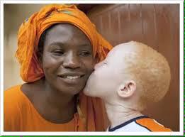 Join us on the albino campaign JE SUIS ALBINOS
Please say stop killing albinos on your profile now
<a href="/jesuisalbinos/">Je Suis Albinos</a>