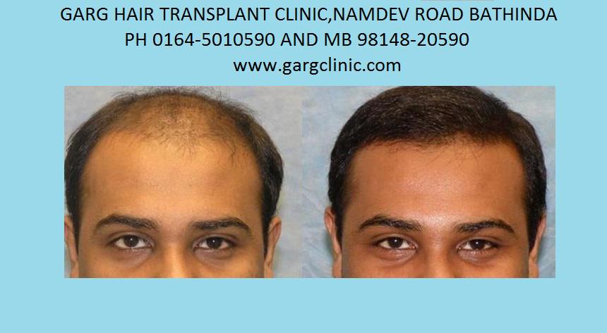 garg hair transplant (@garghairclinic) / Twitter garg hair transplant (@garghairclinic) / Twitter