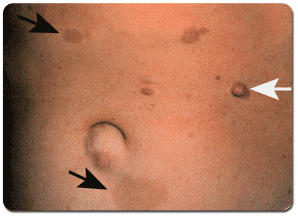 CanerOrgUa's tweet image. #Нейрофиброматоз - cancer.org.ua/neurooncology/…

#новости #онкология #cancer