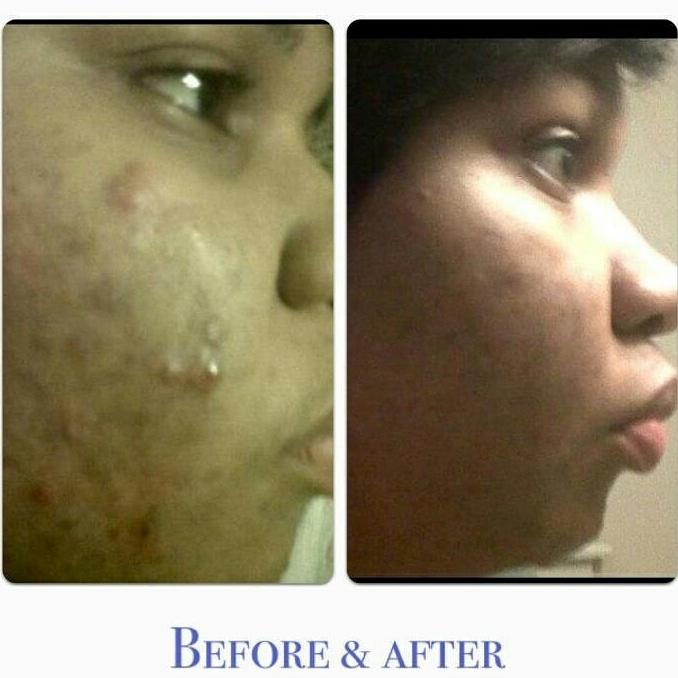 #acnetreatment #razorbumptreatment dm for details on learning how to treat these skin conditions naturally