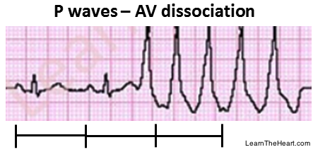 LearntheHeart's tweet photo. AV dissociation during ventricular tachycardia 

Also occurs in 3rd degree AV block

#USMLE #ECG #Cardiology http://t.co/IEy8uyxDNJ