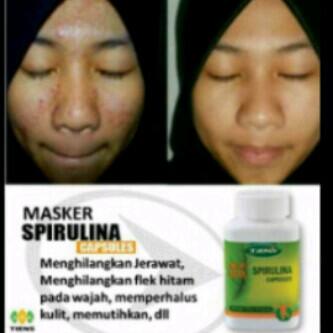 Jgn salah pilih penggunaan masker wajah, bahaya lohh ... Wajah jerawat atasi dgn obat herbal... #spirulina masker...