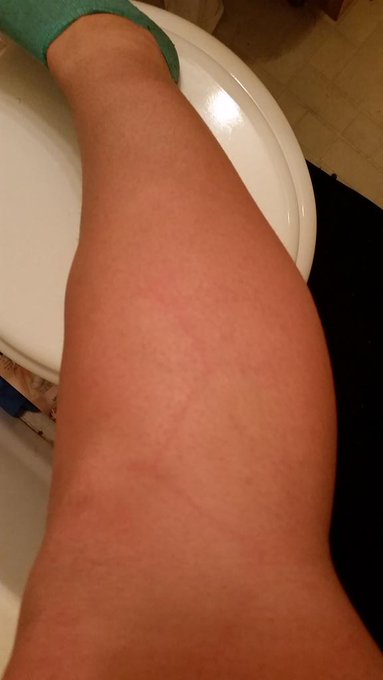 the ball imprinted on my leg and that pump was an insta pump when a dude kicked the fuck out of me and<a href="/tag/squats"class="tags"><span>#squats</span></a><a href="/tag/workit"class="tags"><span>#workit</span></a><a href="/tag/harrypotter"class="tags"><span>#harrypotter</span></a>