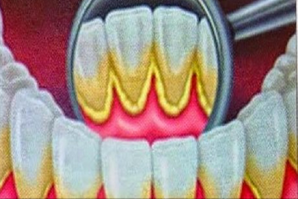 NoticiasCNN_'s tweet photo. Elimina por completo el desagradable sarro de tus dientes.

Ver→ http://t.co/RFhhFsXNHX http://t.co/xt1hWaqnVc