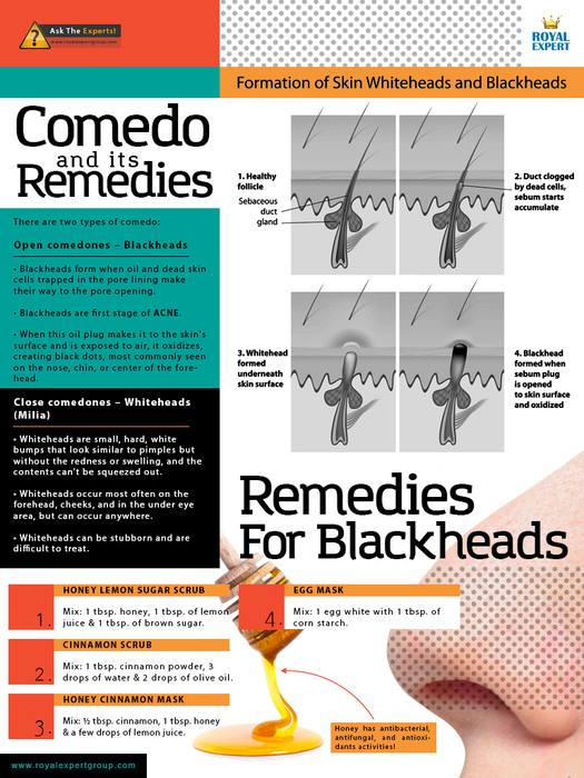 ksharifirad's tweet photo. What do you know about #Comedo on your #Skin ?
#Blackhead #Whitehead
https://t.co/M4zNHszmtQ
https://t.co/mqyW8N6g6b http://t.co/T7MzOWAOAi