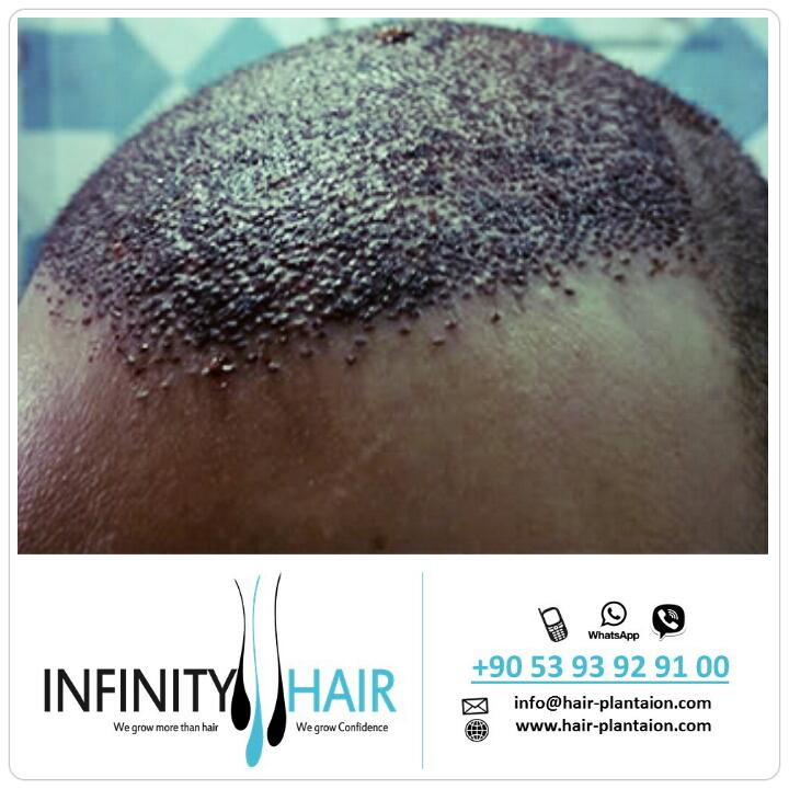infinityturkey's tweet photo. #infinityhair #hairtransplant #turkey #انفينيتي_هير #زراعة_الشعر #تركيا #السعودية #الكويت #قطر #البحرين #الامارات http://t.co/ZgLqnWiDcL