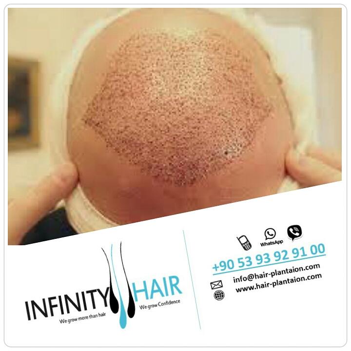 infinityturkey's tweet photo. #infinityhair #hairtransplant #turkey #انفينيتي_هير #زراعة_الشعر #تركيا #السعودية #الكويت #قطر #البحرين #الامارات http://t.co/k0xIG9rEa9