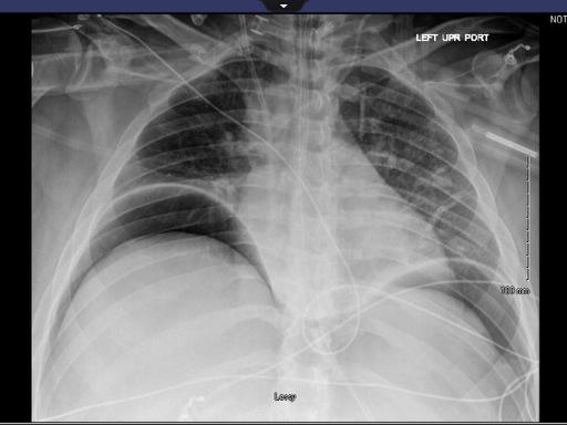 jamie_rae_EMdoc's tweet image. Same patient's upright chest #NotSoSubtle #emergencymedicine #radiology