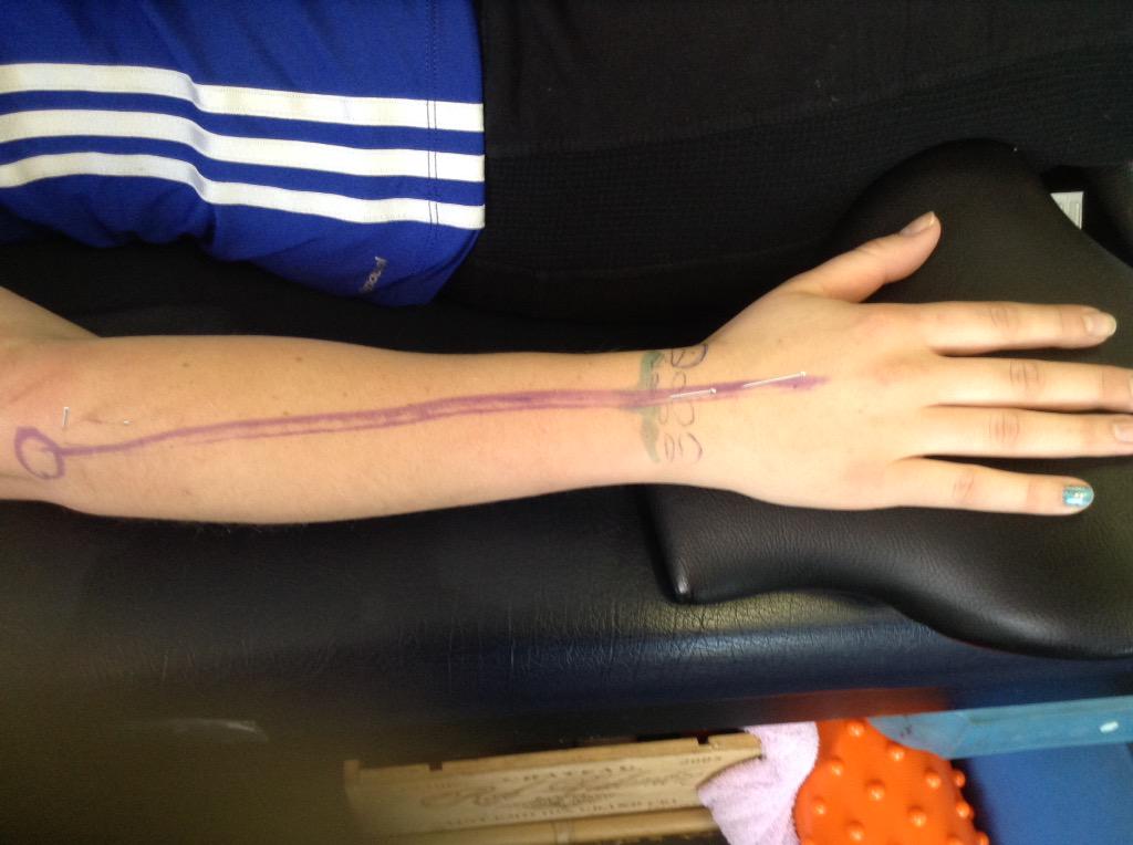 Unstablephysio's tweet photo. @Unstablephysio: #needlecrazy. What is happening at ABC today?  Start of summer tendinitis. #paininwrist http://t.co/l2ZpuTz5RJ