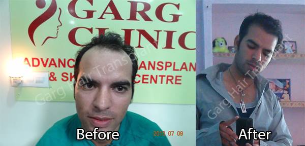 garg hair transplant (@garghairclinic) / Twitter