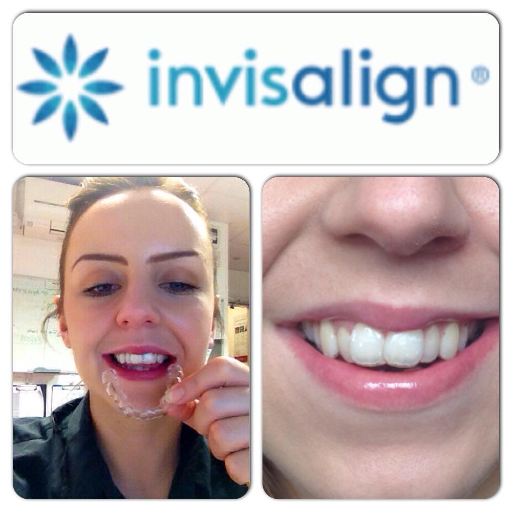 hayley5mith's tweet photo. So happy about my braces! Would defiantly recommend @Invisalign to everyone! #invisalign http://t.co/e7No48ni4a
