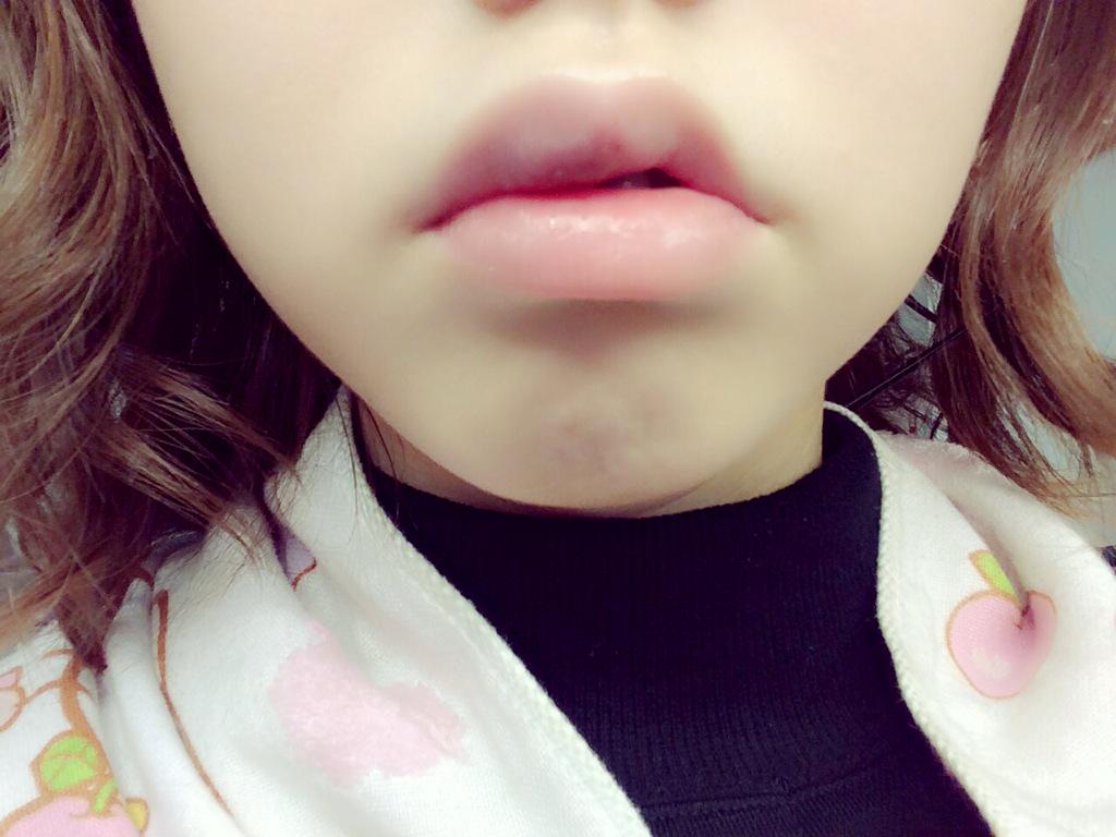 峯岸みなみに 唇が腫れる 異変 前日に顔面打撲をtwitterで報告 ライブドアニュース 峯岸みなみに 唇が腫れる 異変 前日に顔面打撲をtwitterで報告 ライブドアニュース