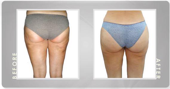MantisItalia's tweet photo. Before and After. Guarda i risultati! #beauty #estetica #bellezza #dimagrimento http://t.co/NZ1qmKqD97