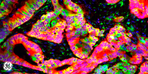 GEHealthCare's tweet photo. Shooting Disease with Silver Bullets: using "precision medicine" to help defeat #cancer http://t.co/frjjVMx0rJ http://t.co/36T0hbR4G5