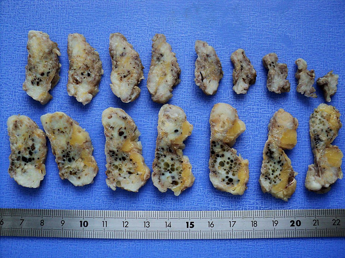 intraductal papilloma fibrocystic changes
