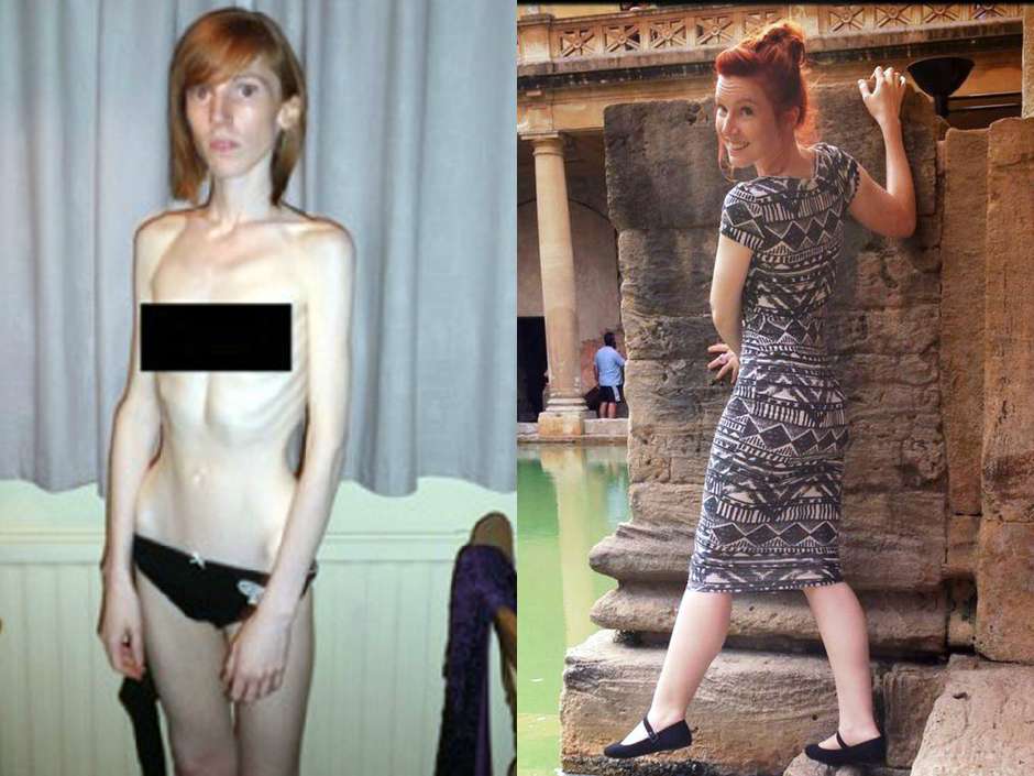 terrabrasil_nos's tweet photo. Só isso? Jovem que venceu anorexia consumia 10 calorias por dia
http://t.co/igHuSJ9reD
#anorexia #bethhall http://t.co/NyNHKMoi2J