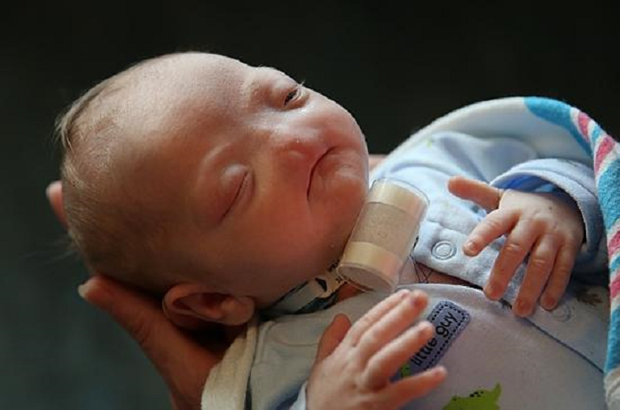 LifeNewsHQ's tweet photo. Facebook Lifts Ban on Picture of Baby Born Without a Nose That it Called “Shocking” http://t.co/a5S1ygw1ee http://t.co/LcilIdi9Mj