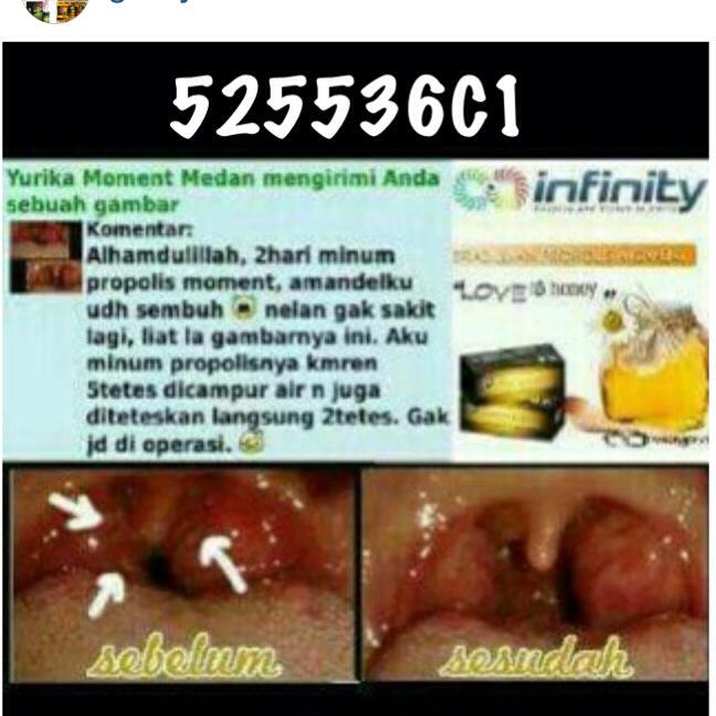 Batal operasiii krn propolis 😊😊