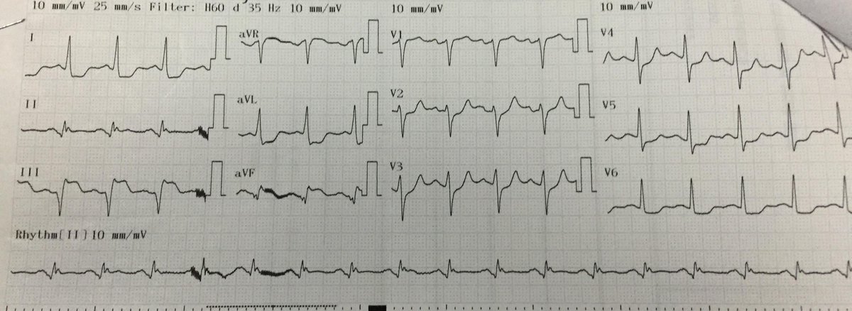 umanamd's tweet image. 45y/o M w/ chest pain and palpitations.
After electrical CV, second ECG showed…
#hadtochangemypants
#codeSTEMI
#cath