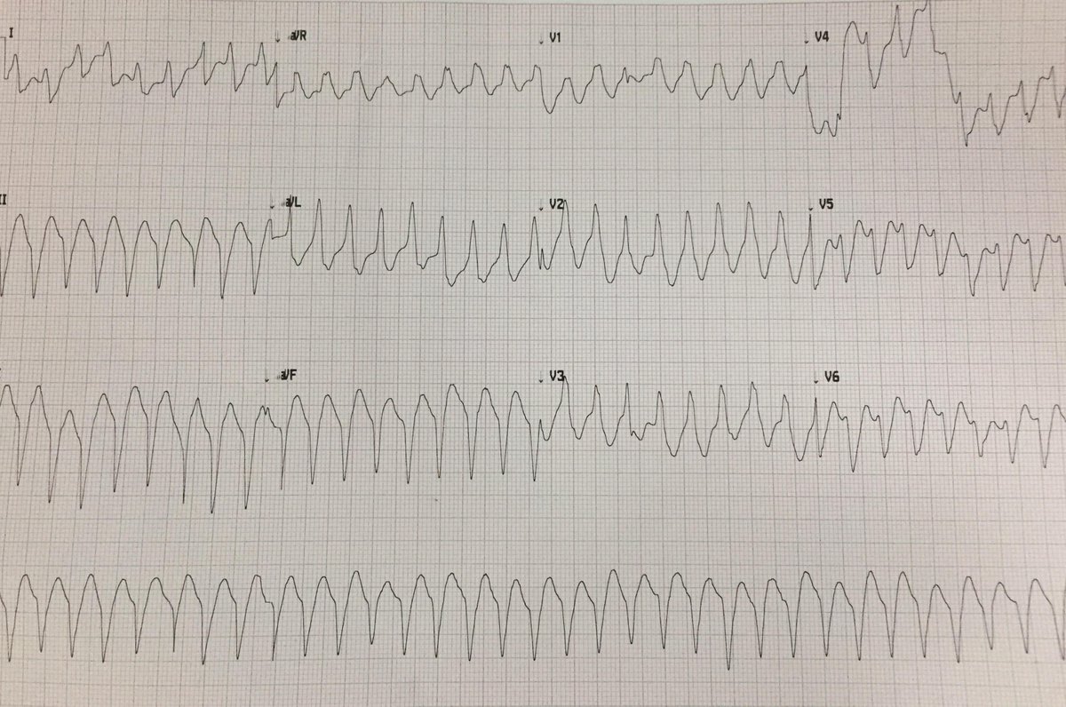 umanamd's tweet image. 45y/o M w/ chest pain and palpitations.
After electrical CV, second ECG showed…
#hadtochangemypants
#codeSTEMI
#cath