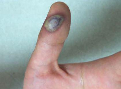 Lab-Acquired Vaccinia Virus Infection in a Recently Immunized Person — Massachusetts, 2013 go.usa.gov/3BAMB