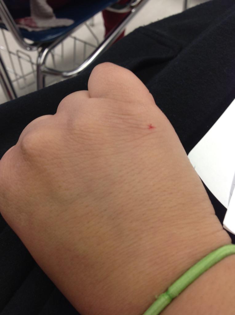 DCAPHUGSelina's tweet photo. I got hurt in the line of duty.Writing tally marks is not an easy job. #iscore5 #APHUG @JasAzimuth @DCAPHUG_AdamR http://t.co/M7jZ7Xntvf