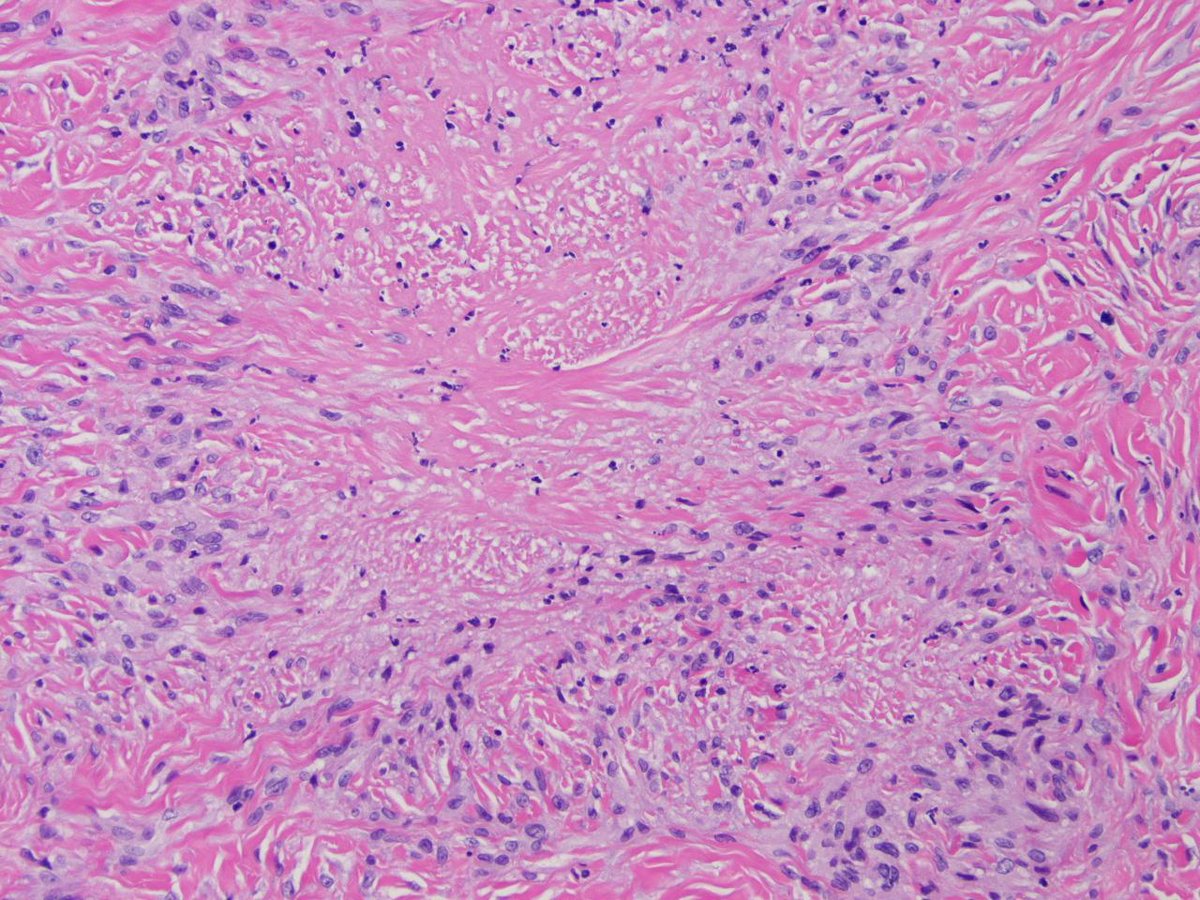 keithkaplanmd's tweet photo. 55 y/o male with diabetes - shin biopsy.
Necrobiosis lipoidica http://t.co/XWMU5uefc6