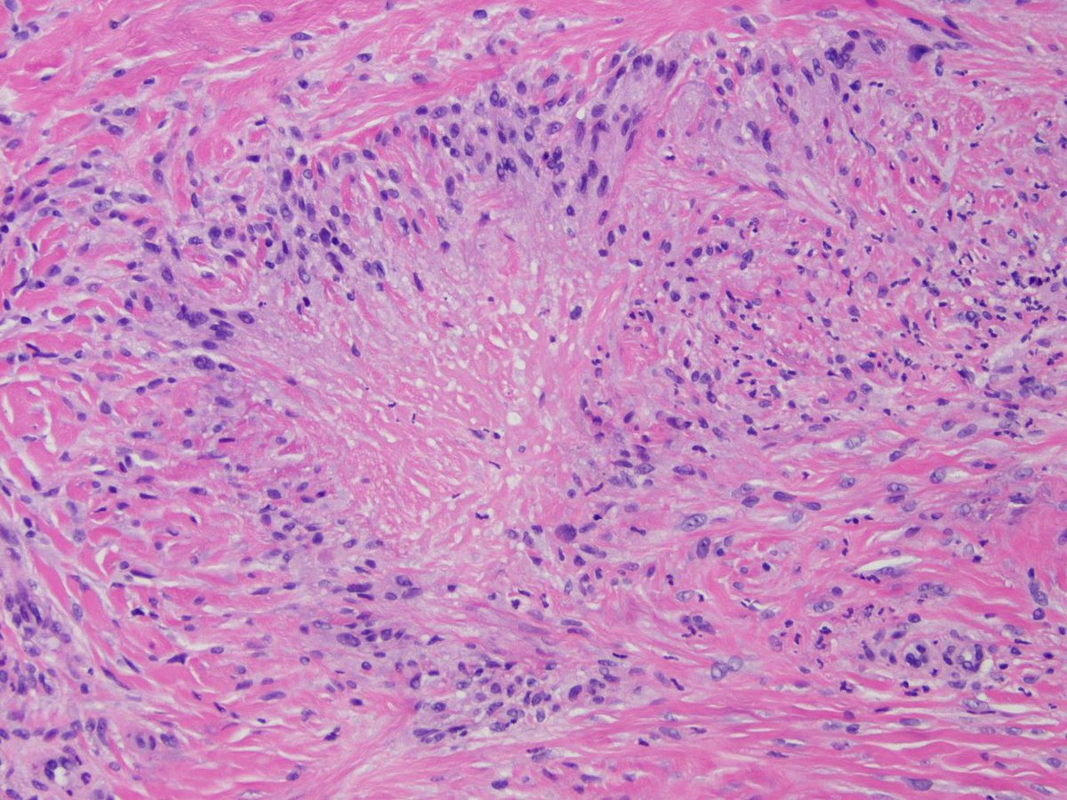 keithkaplanmd's tweet photo. 55 y/o male with diabetes - shin biopsy.
Necrobiosis lipoidica http://t.co/XWMU5uefc6