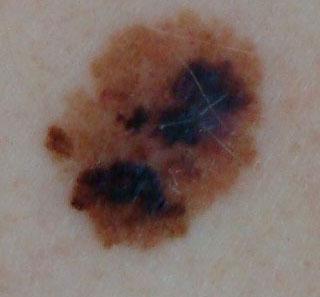 PoschChristian's tweet image. #MelanomaAwarenessMonth - let's get ready with some simple hints:
A-asymmetry
B-border
C-color
D-diameter
E-evolution