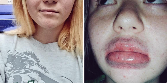 MTVUK's tweet photo. The #kyliejennerchallenge took over social media last night &amp; it's pretty scary http://t.co/g0Hn3Zfvm0 http://t.co/RKS4crJ79Z