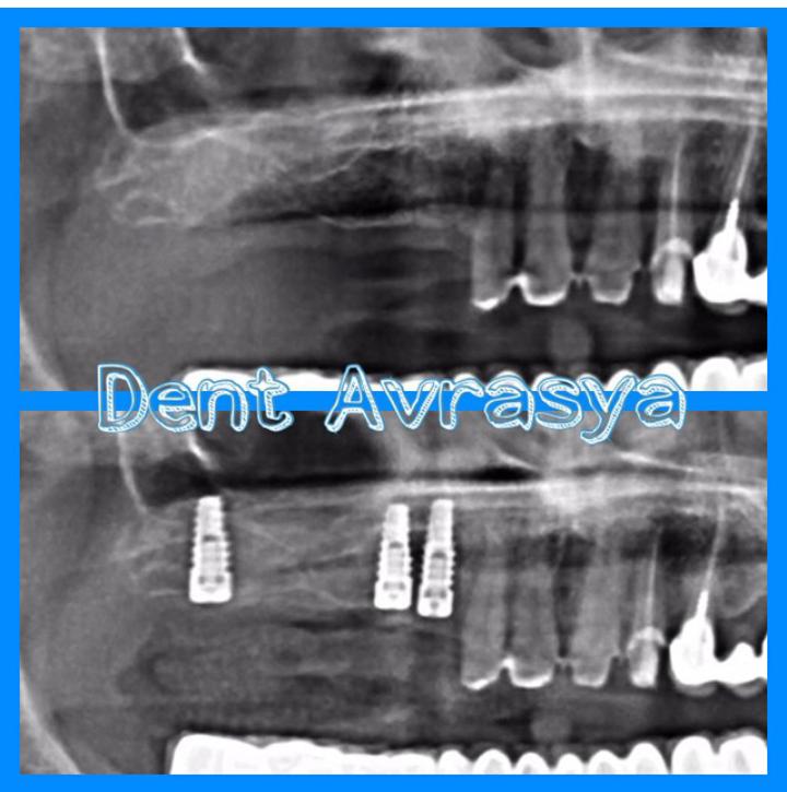 Implant tedavisinin biravantajı da sonu dişsiz vakalarda sabit protez yapabilme imkanı sunabilmesidir #dentalimplants