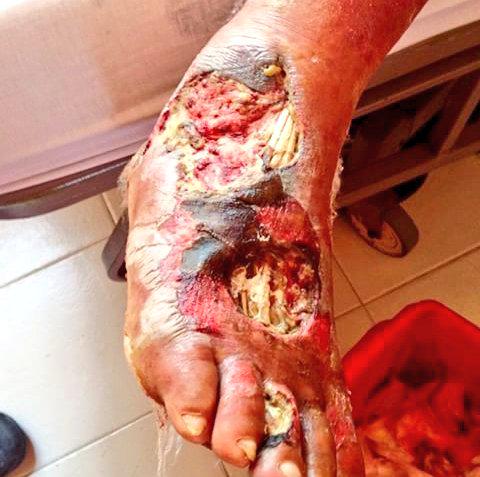 3rd degree road rash 3rd degree road rash
