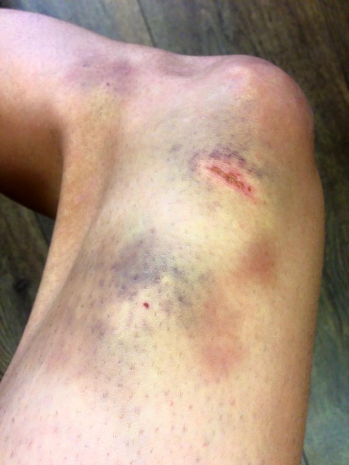 How Mojsov's knee looked on Tuesday