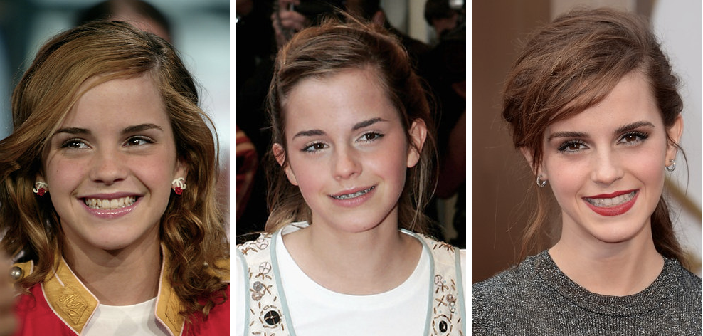 14 Celebrities Who Prove Braces Can Change Your Entire Face Scoopnest 14-celebrities-who-prove-braces-can-change-your-entire-face-scoopnest