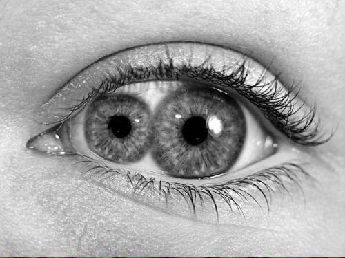 Double Iris/Pupula duplex - An extremely rare condition when there are two pupils in one eye.
