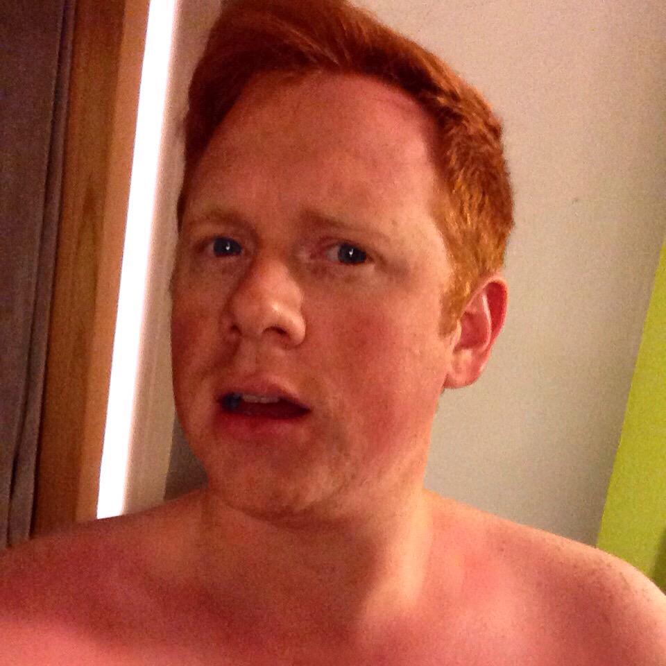 DanielBamforth's tweet image. Oops! Too much sunshine today. #Burnt #GingerProblems #Sunburn