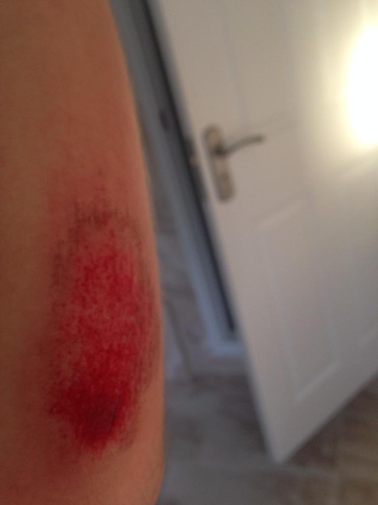 Milso's tweet photo. Fell over whilst running. Done me shoulder in !! Doh! http://t.co/3TwPDxElgL