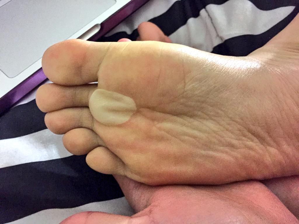 leticyachantel's tweet image. This blister tho....... #runnersproblem #theoneonmyotherfootisworse #irun #alot