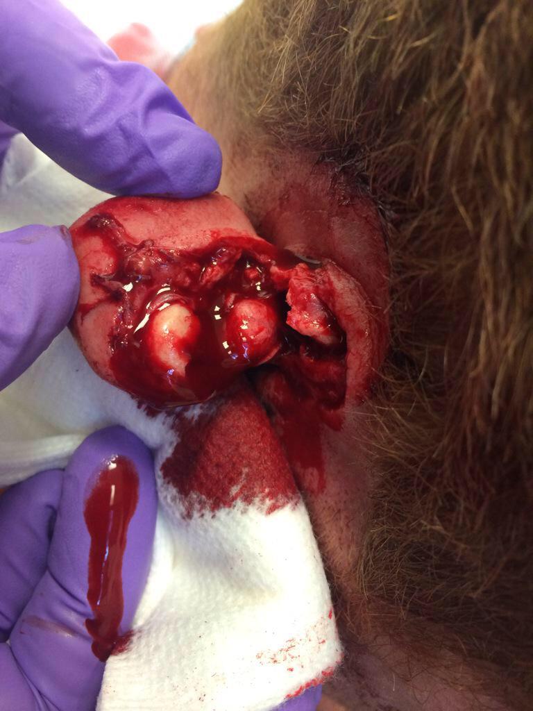 eatsleeprugby's tweet photo. Wishing Heriot's Davy McGregor all the best for the surgery on possibly the worst ear injury we have ever seen. http://t.co/vK0PKWwJ1j