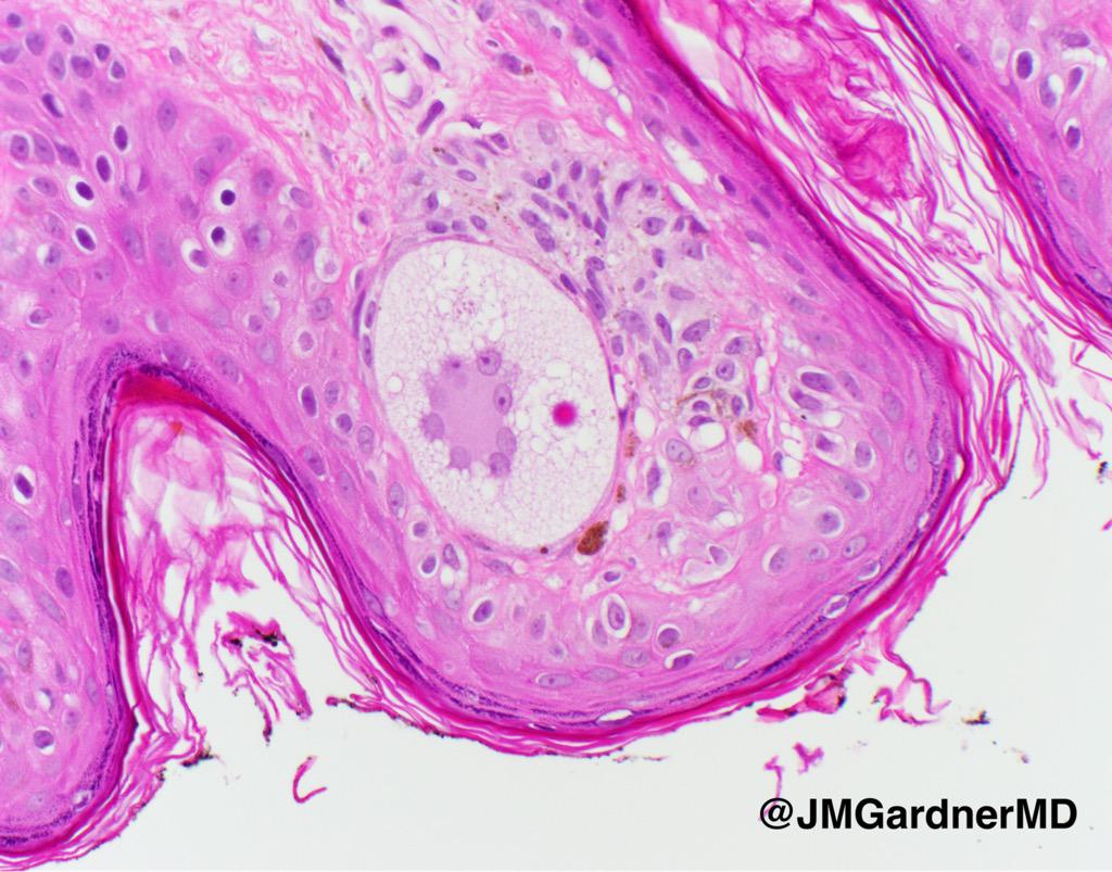 JMGardnerMD's tweet photo. My favorite melanocyte ever. Multinucleated w/ tiny pink "sun" cytoplasmic inclusion (zoom in). #pathology #Dermpath http://t.co/pWXNvBvENO