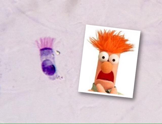 DrLesliesPath's tweet photo. Every time I see an endobronchial cell I think of Beaker from @TheMuppets #pathology #nerd http://t.co/sGfUvubyPH