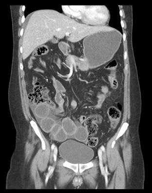 RadiologySigns's tweet photo. Q: Urgent diagnosis and surgery required here. What is it? ANSWER: http://t.co/oo9iwVYzBF #FOAMrad #FOAMed http://t.co/NrmhqnOcvC