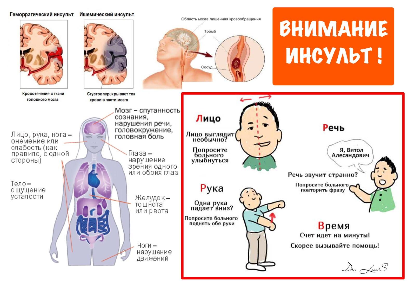 Инсульт симптомы фото