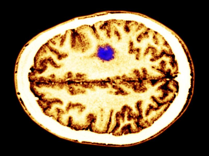 npratc's tweet photo. Thoughts Can Fuel Some Deadly Brain Cancers http://t.co/tj07QXWheT http://t.co/x5dAEDHqZI