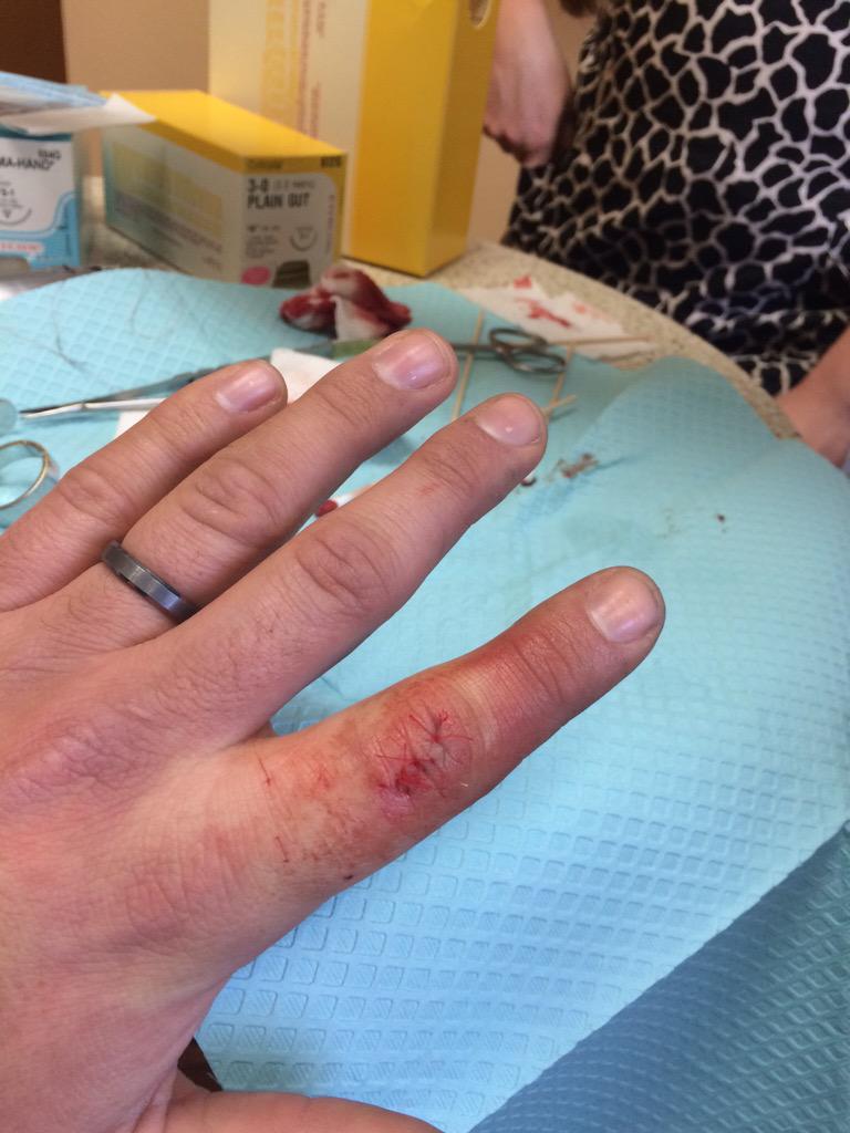 CSMITH406's tweet photo. All better after 6 stitches and some big ass needles in my finger. http://t.co/KxXSp4RMTO