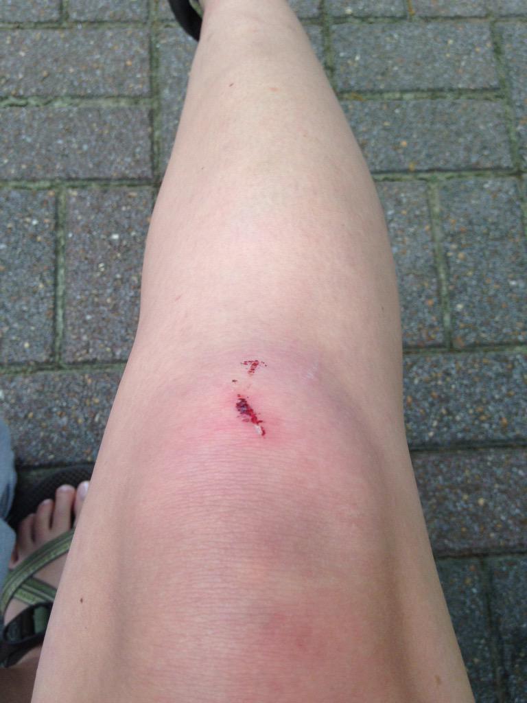 mkhowey's tweet photo. @jlsquaredd I also got an injury from the table @ Edgewood... http://t.co/g0Z7JtAcfo