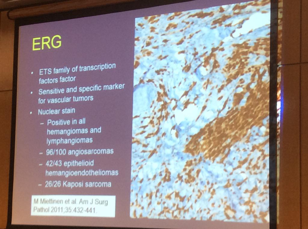 HassellLewis's tweet image. ERG IHC can be highly useful Dr. Billings #sarcoma #OSAP15